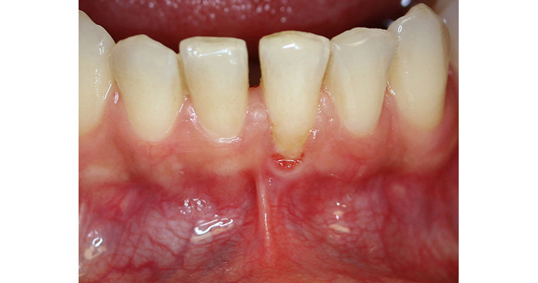 Der Alleskönner Laser: Abb. 6 Lippenbändchen zwischen den Zähnen 31 und 41 mit progredienter Ausbildung einer entzündlich parodontalen Rezession an
Zahn 31 bei eingeschränkter Reinigungsmöglichkeit.
