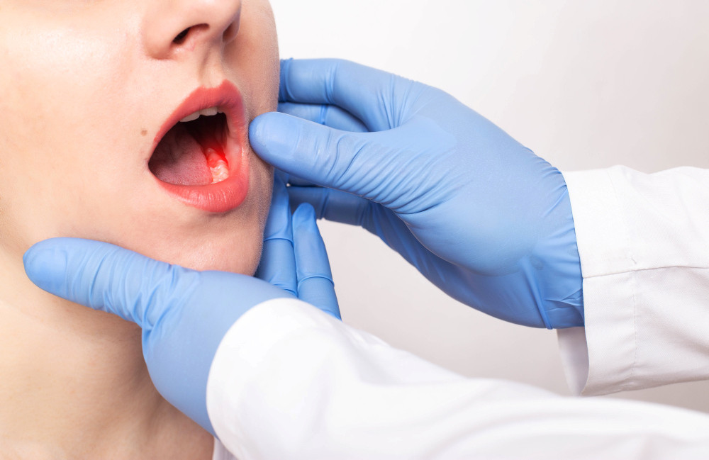 Veränderungen in der Mundhöhle wie nicht heilende Wunden oder Schwellungen können Anzeichen für Mundhöhlenkrebs sein.