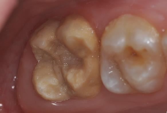 Abb. 3 Schwere Form der MIH. Dieser Zahn brach unvollständig entwickelt in die Mundhöhle durch. Der Molar war hochgradig kälte- und berührungsempfindlich. Die Beläge auf der Oberfläche geben einen Hinweis darauf, dass selbst das Putzen der Zähne nu