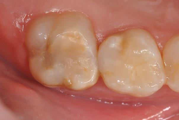 Abb. 4 Mittel der Wahl zur Versorgung der MIH-Zähne sind Kompositfüllungen. Der Kleber versiegelt effektiv die erkrankte Oberfläche und Komposit gilt als guter Isolator gegen die Noxen. Zusätzlich kann die gesunde Zahnhartsubstanz optimal geschont wer