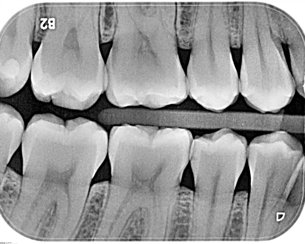 Röntgenausgangsbild mit nichtkavitierter Karies in der inneren Schmelzhälfte an Zahn 45 distal
