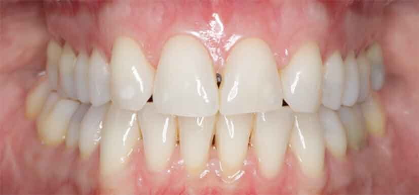 Abb 1: Beispiel eines dünnen Phänotyps, bei dem das Risiko der Dentinfreilegung größer ist als bei einem dicken Phänotyp