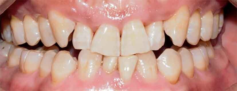 Abb 2: Beispiel eines dicken Phänotyps, bei dem das Risiko der Dentinfreilegung geringer ist als bei einem dünnen Phänotyp 