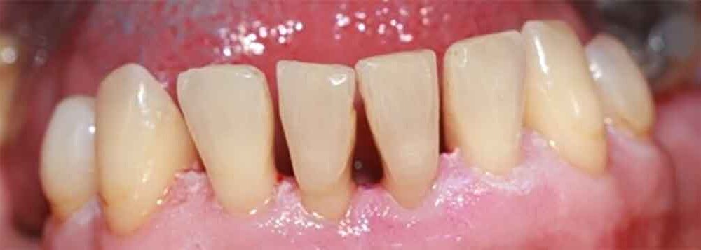 Abb 3: Rezessionen mit Dentinfreilegung nach erfolgter Parodontitisbehandlung  