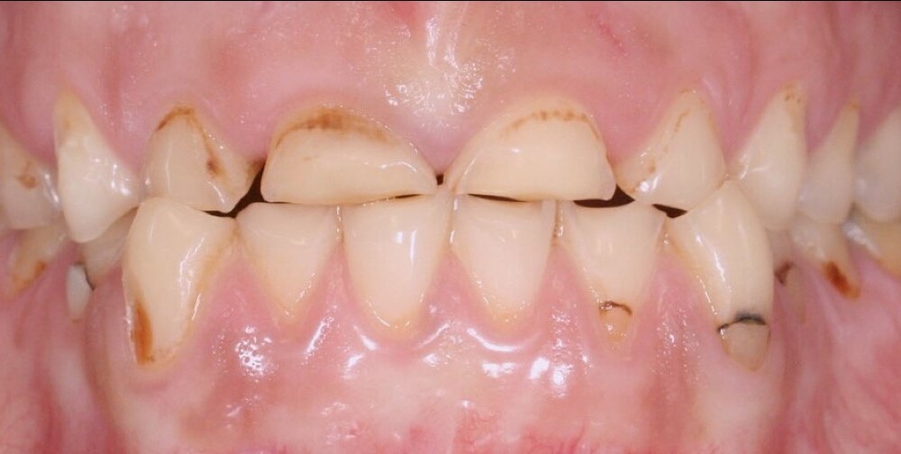 Schwer beschädigte Zähne einer Bulimie-Patientin vor der Behandlung