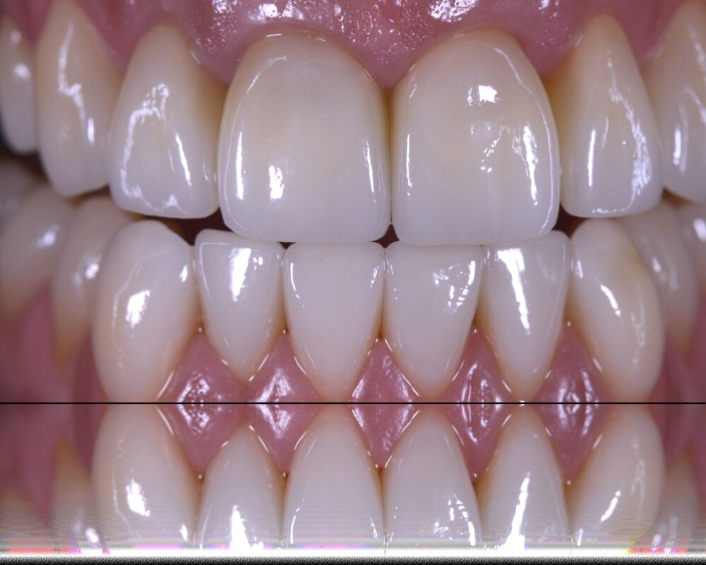 Schwer beschädigte Zähne einer Bulimie-Patientin nach der Behandlung.