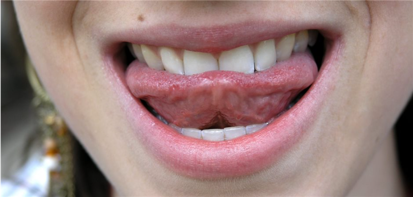 Wie steht es um die Mundgesundheit? Dieser Frage sollte einer Studie zufolge bei Patientinnen und Patienten mit Hirnabszessen ohne erkennbare Ursache nachgegangen werden.