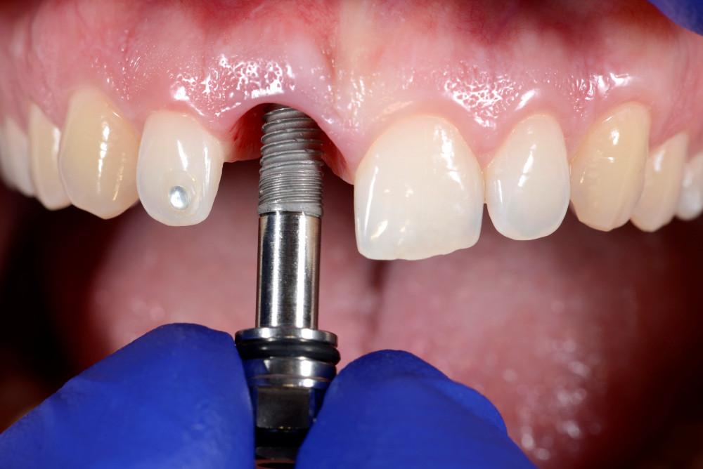 Photo of procedure of dental implantation. Selective focus.