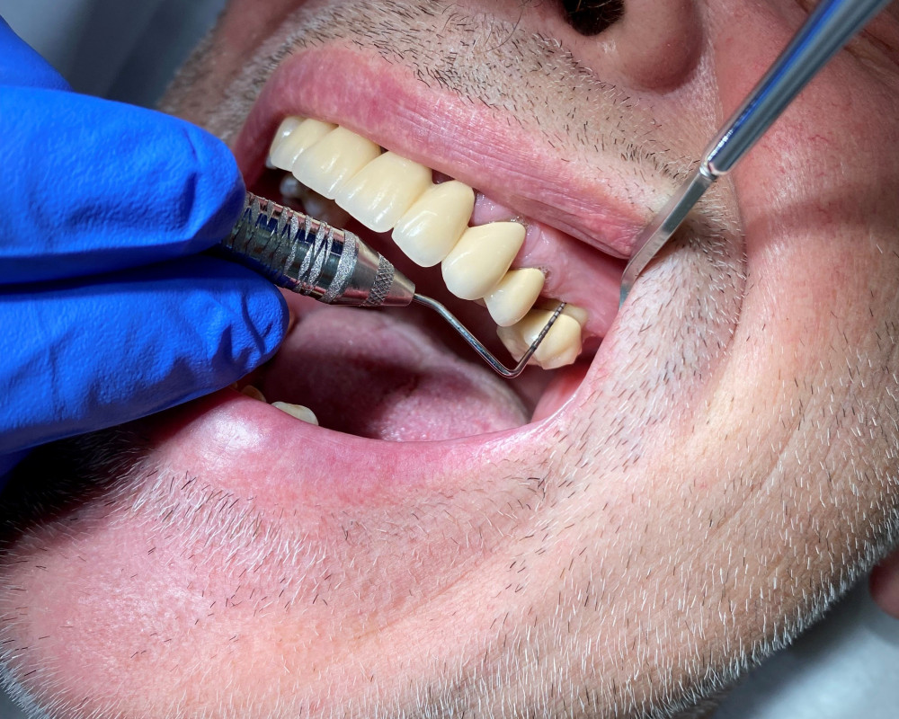 Die Kontrolle der Zahnfleischtaschen (bis 3 mm gesund) mit einer speziellen parodontalen Sonde.