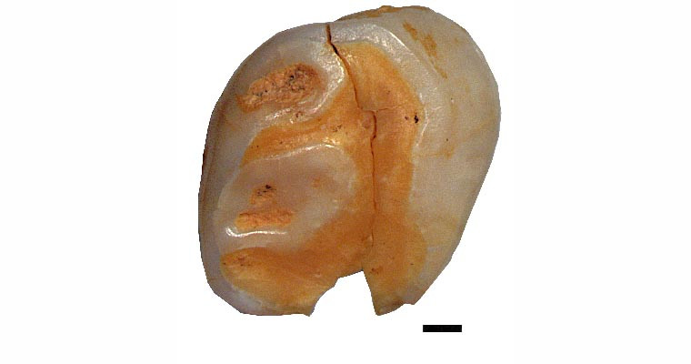 Neanderthaler-Milchzahn: Vermutlich beim Zahnwechsel verlor ein Neanderthaler-Kind vor 40.000 bis 70.000 Jahren diesen Milchzahn