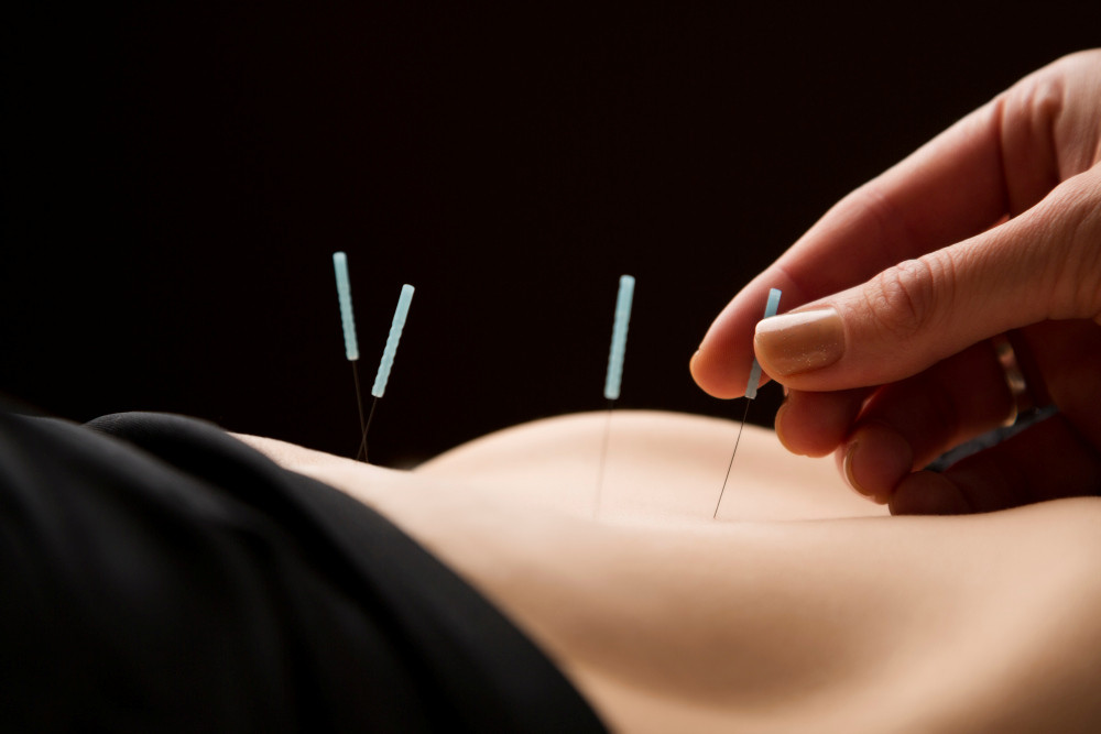 Akupunkturnadeln und weibliche Hand