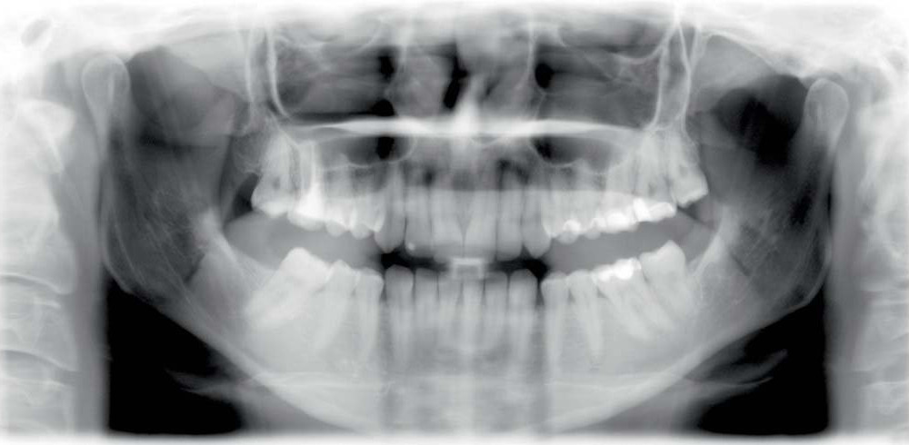 Röntgenaufnahme Zahnstatus