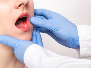 Veränderungen in der Mundhöhle wie nicht heilende Wunden oder Schwellungen können Anzeichen für Mundhöhlenkrebs sein.