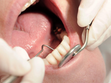 Zahnarzt untersucht auf Parodontitis thb