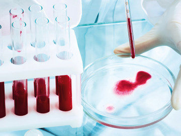 Bluttest: Chinesische Forscher haben einen Test entwickelt, der auf der Basis typischer DNA-Methylierungsmuster Krebserkrankungen bereits Jahre vor der Diagnose anhand von zirkulierender Tumor-DNA im Blutplasma erkennen soll.