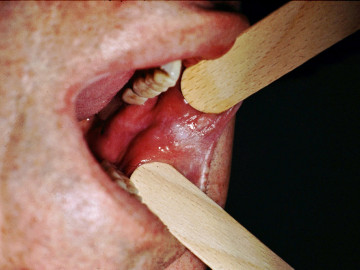 News Drastisch veränderte Mundflora bei Krebs