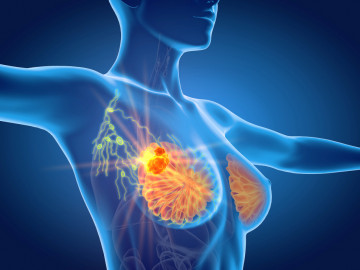 Grafik einer Brust mit Knoten