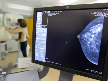 Mammografie: Die Screening-Programme unterscheiden sich von Land zu Land.