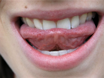 Wie steht es um die Mundgesundheit? Dieser Frage sollte einer Studie zufolge bei Patientinnen und Patienten mit Hirnabszessen ohne erkennbare Ursache nachgegangen werden.