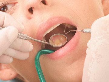 Welche Auswirkungen haben Zahnfehlstellungen auf Zahnfleischerkrankungen? Dieser Frage gingen Greifswalder Wissenschaftler mit teils überraschenden Ergebnissen nach.