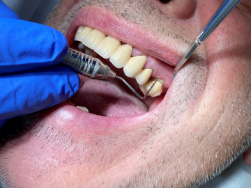 Die Kontrolle der Zahnfleischtaschen (bis 3 mm gesund) mit einer speziellen parodontalen Sonde.