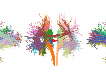 Das Gehirn von Neugeborenen enthält eine Vielzahl von Nervenbahnen, die ein Team aus der Neurowissenschaft mit Magnetresonanztomografie untersucht hat.