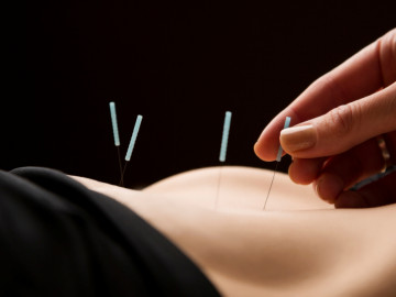 Akupunkturnadeln und weibliche Hand