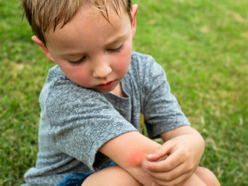 Kleiner Junge mit Mückenstich am Arm
