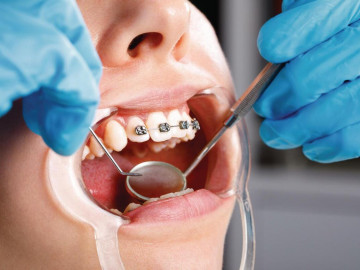 Teenager mit Zahnspange beim Zahnarzt
